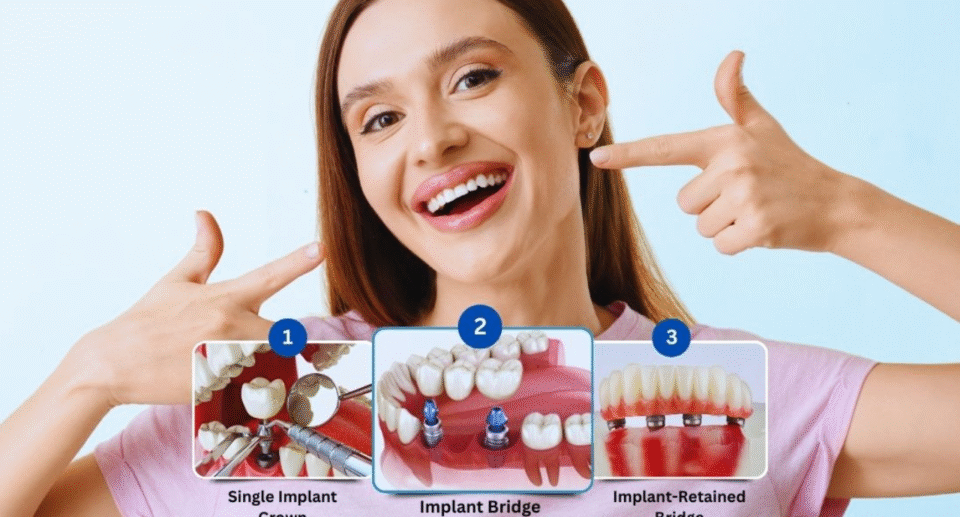Types of Dental Implants: Everything You Need To Know for Perfect Treatment
