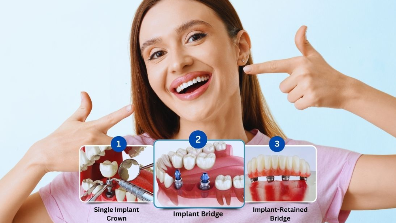 Types of Dental Implants: Everything You Need To Know for Perfect Treatment