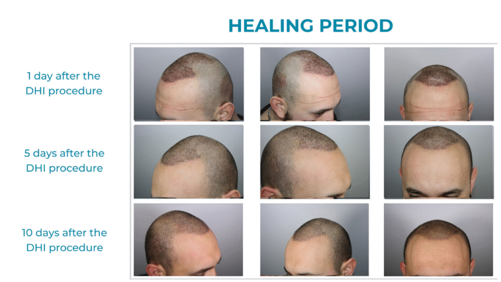 Hair Transplants