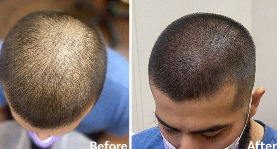 Best Scalp Micropigmentation Los Angeles: Real Results for Hair Regrowth