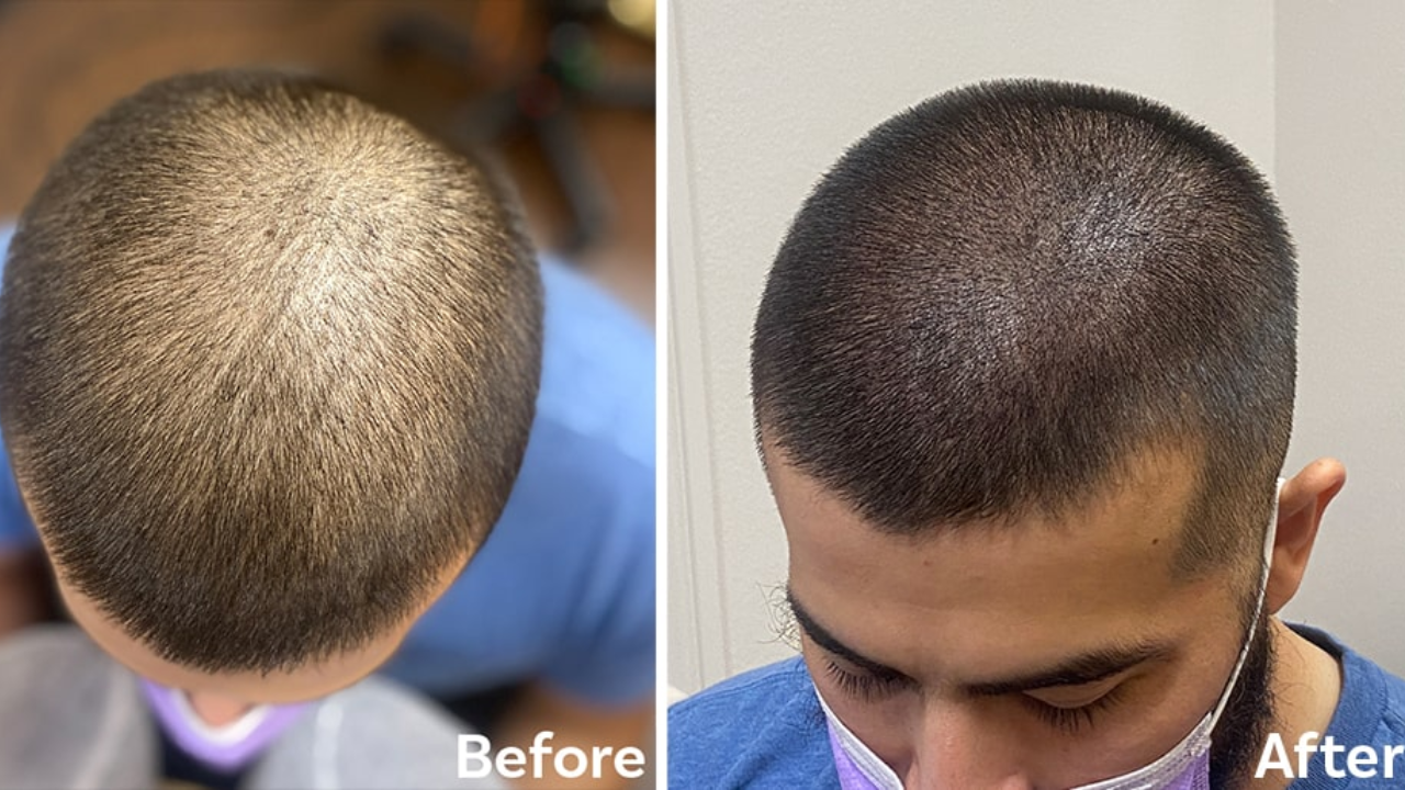 Best Scalp Micropigmentation Los Angeles: Real Results for Hair Regrowth