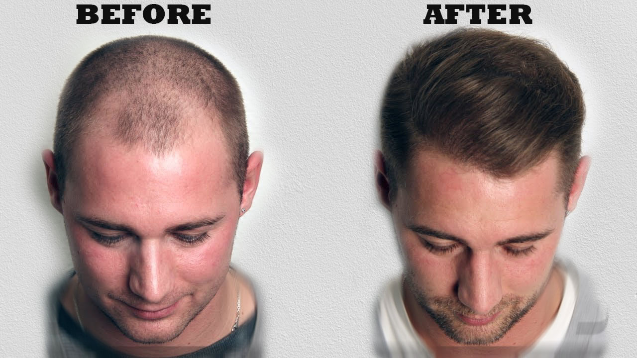 Hair Transplant Hacks: What You Should and Shouldn’t Do for Perfect Results
